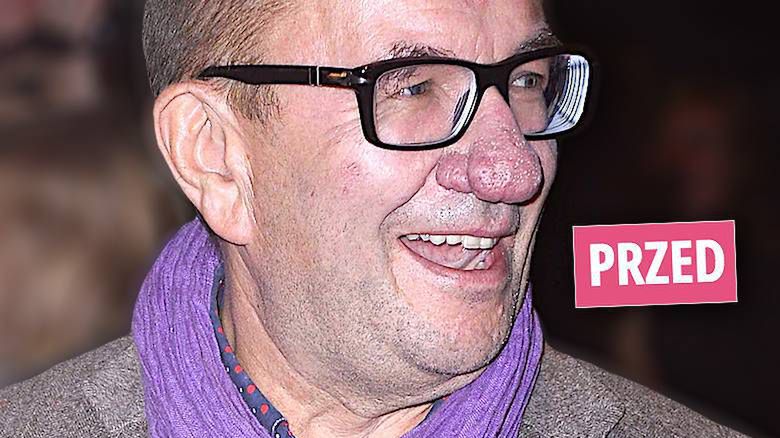 Rafał Bryndal nos, przed i po