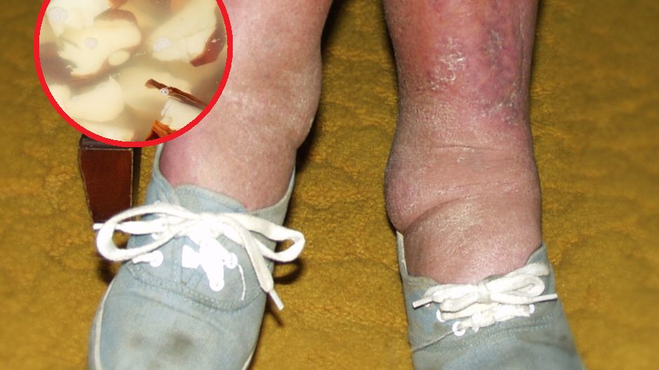 Babcia nalewka na problemy z reumatyczne