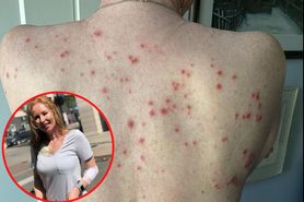 Zmiana pojawiła się na czole kobiety. "Jest jak polewanie kwasem. Dosłownie skwierczy"