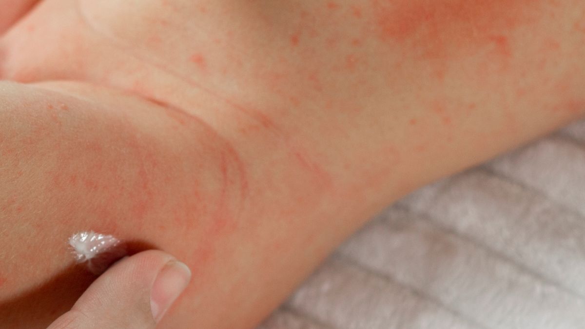 Potówki u niemowląt zwykle nie wymagają specjalistycznego leczenia