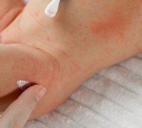 Potówki u niemowlaka: objawy, przyczyny, leczenie