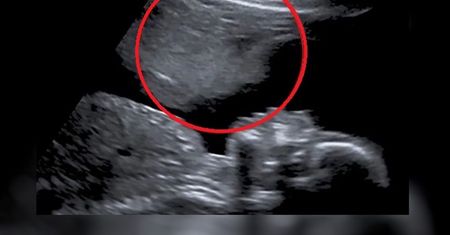 Poroniła trzy razy. To zobaczyła na kolejnym USG