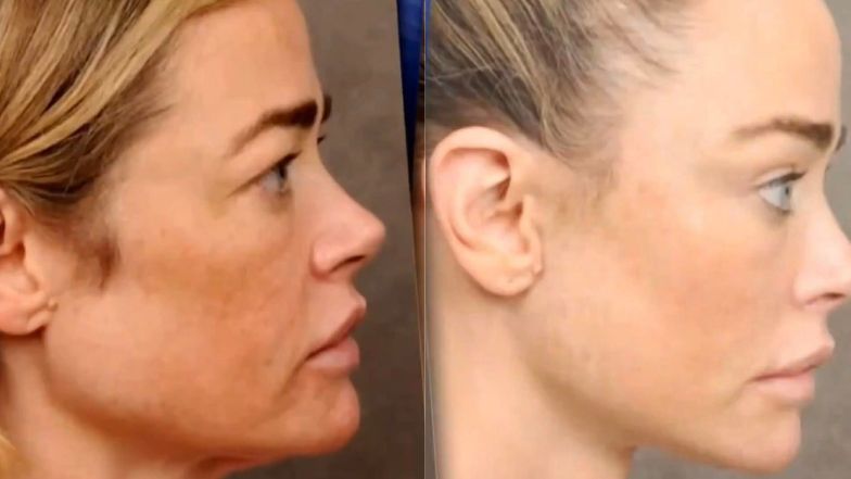 Denise Richards pokazała nagranie z liftingu twarzy