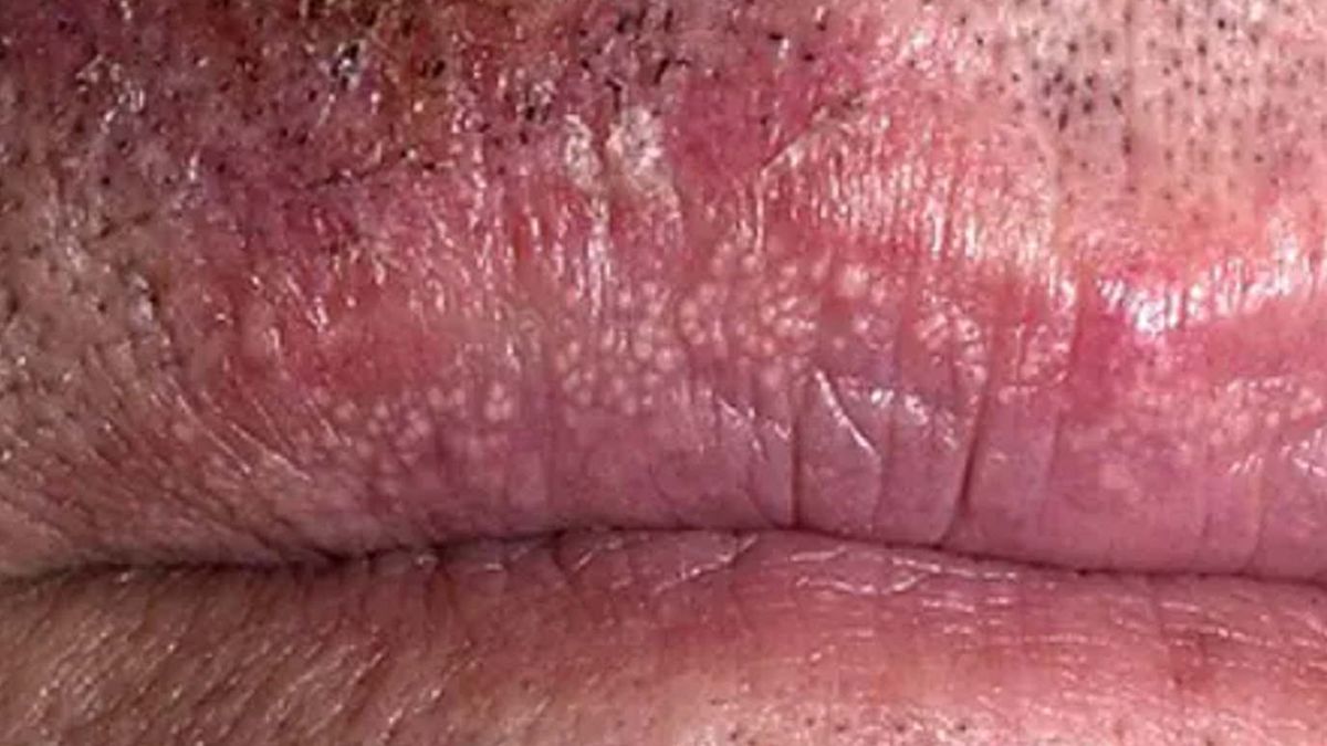 Plamki Fordyce'a często pojawiają się wokół ust