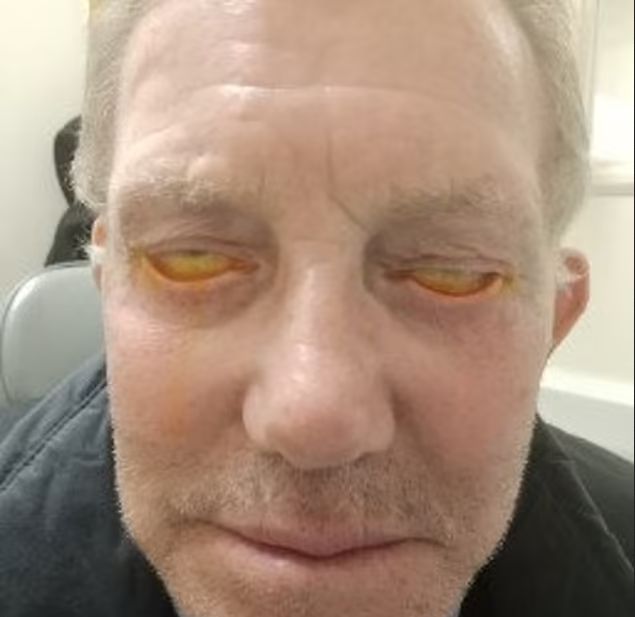 Mężczyzna obawia się o swój wzrok