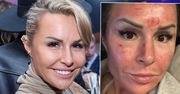 Blanka Lipińska z posiniaczoną twarzą. Wygląda, jakby wdała się w bójkę