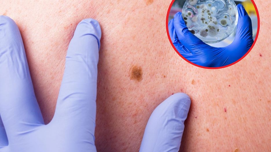 Pierwszym objawem była zmiana skórna. Okazało się, że roczny chłopiec zakaził się wąglikiem