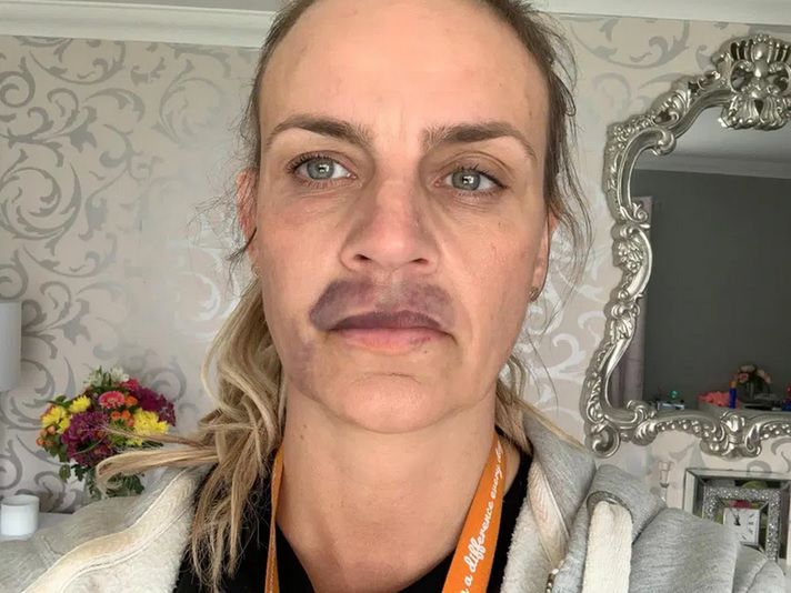 Wypełniacz oszpecił jej twarz