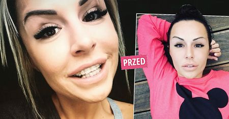 Blanka Lipińska ma nowe, śliczne ząbki. Teraz o tytuł najpiękniejszego uśmiechu może rywalizować z Piaskiem i Ibiszem