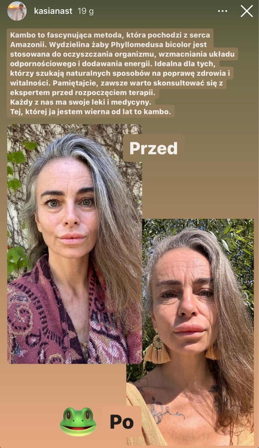 Kasia Nast wstrzyknęła sobie jad żaby