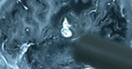 Nagły paraliż 23-latka. Przerażające, co wyciągnęli z jego mózgu