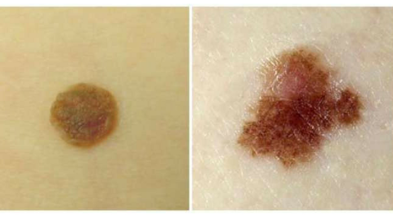 Kształt znamion i pieprzyków