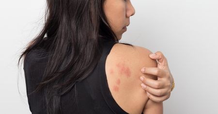 Pokrzywka alergiczna - przyczyny, objawy i leczenie
