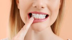 Odwapnienie zębów - przyczyny, objawy, leczenie, wybielanie szkliwa