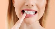 Odwapnienie zębów - przyczyny, objawy, leczenie, wybielanie szkliwa