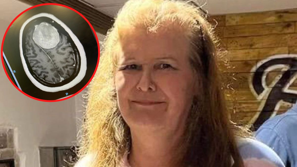 Zdjęcia z badania MRI pokazuje, jak duży był guz