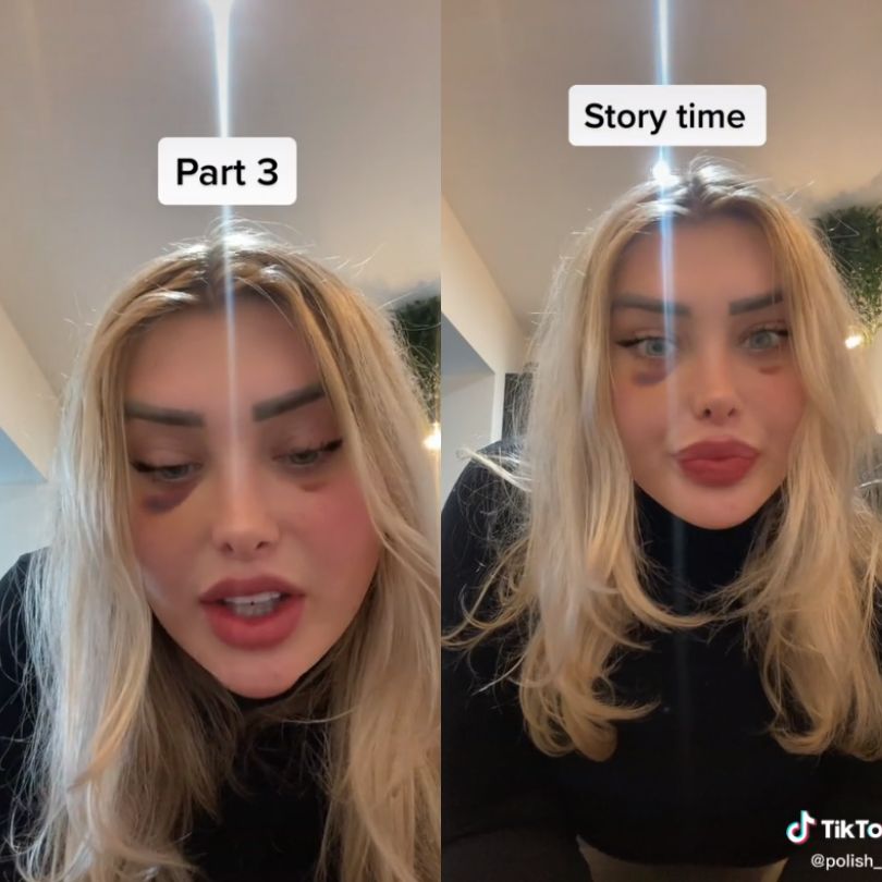 Tiktokerka wspomina dramat podczas lotu samolotem po zabiegach