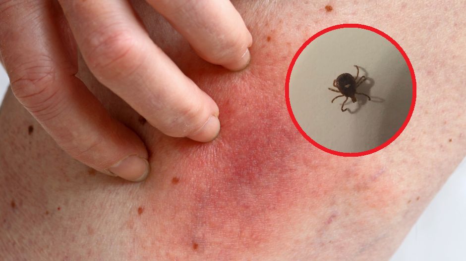 W przypadków objawów po ukłuciu przez kleszcza, trzeba jak najszybciej zgłosić się do lekarza