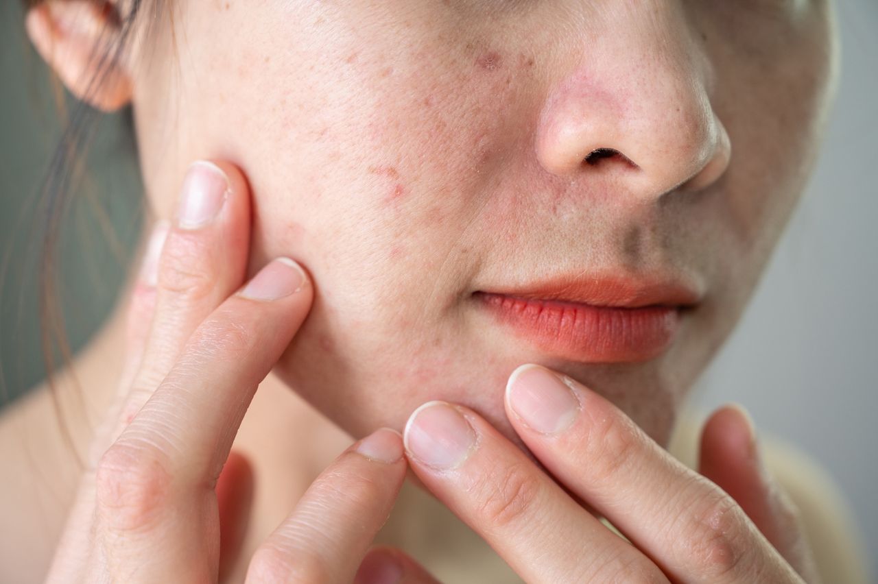 Have you noticed on your skin? It's a signal that you might be overdoing it with sugar.