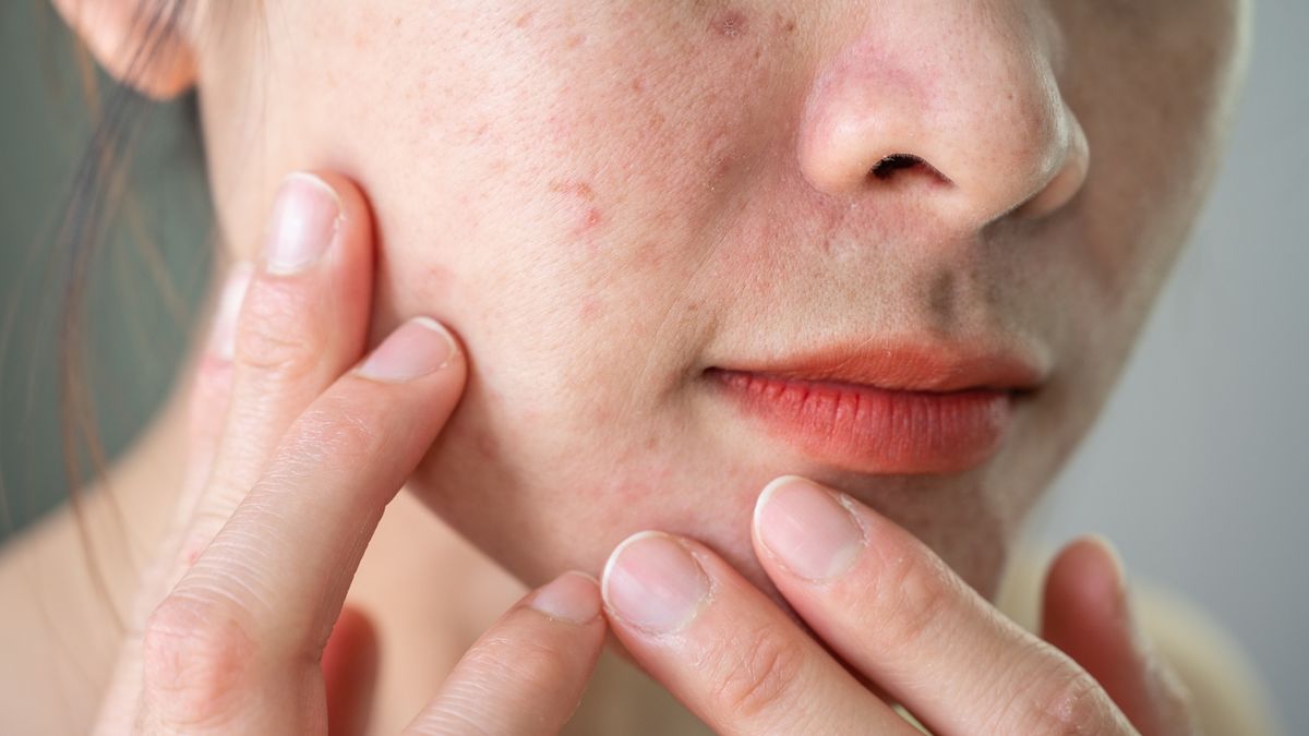 Cropped shot of Asian woman having wrinkled and acne scar occur on her face.
Wrinkles are folds or creases that appear on the face and body as the skin loses elasticity and the amount of collagen.
Boy_Anupong