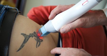 Usuwanie tatuażu. Najczęściej stosowane metody