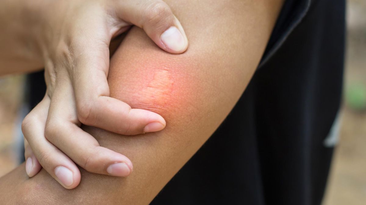 Użądlenie może się skończyć silną reakcją alergiczną, a w skrajnych przypadkach wstrząsem anafilaktycznym