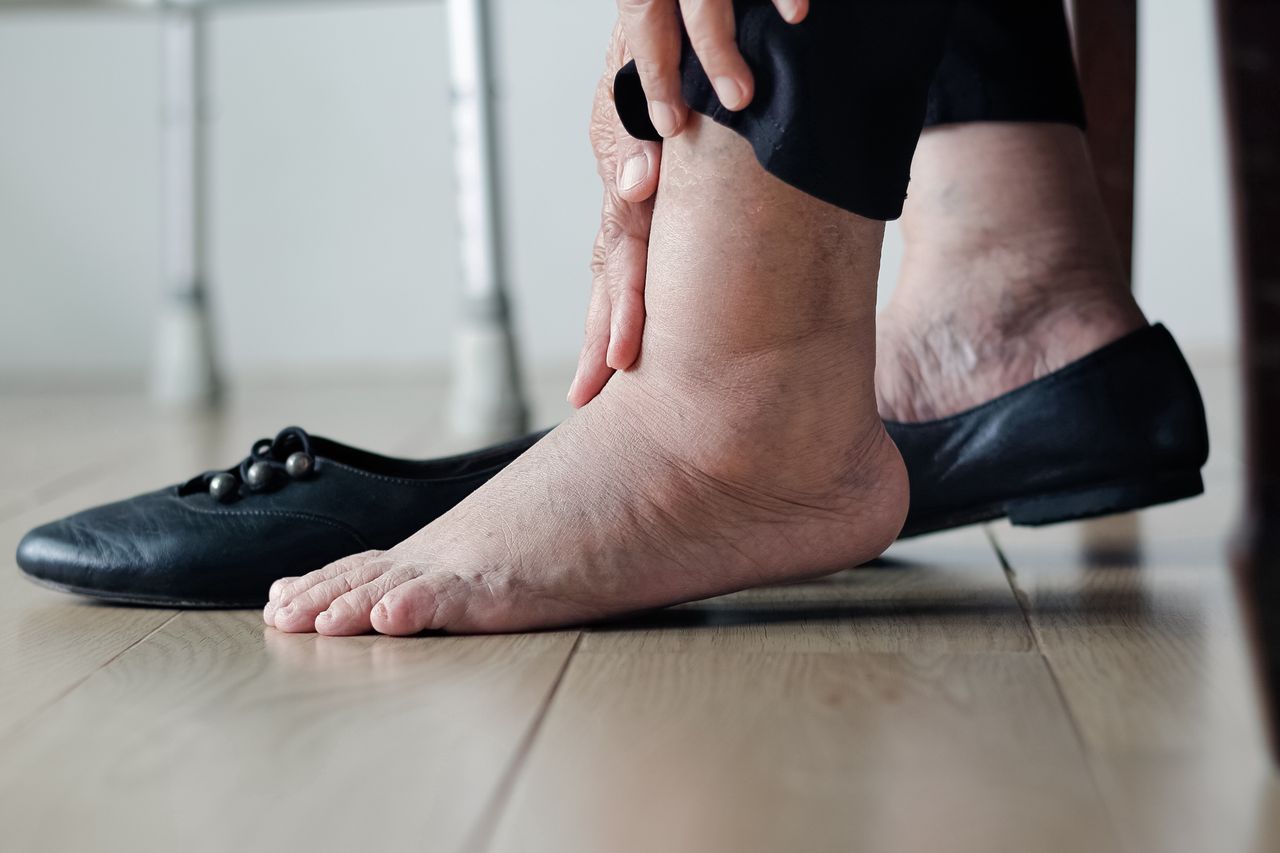 Latem puchną ci stopy? Dietetyk mówi, czego unikać