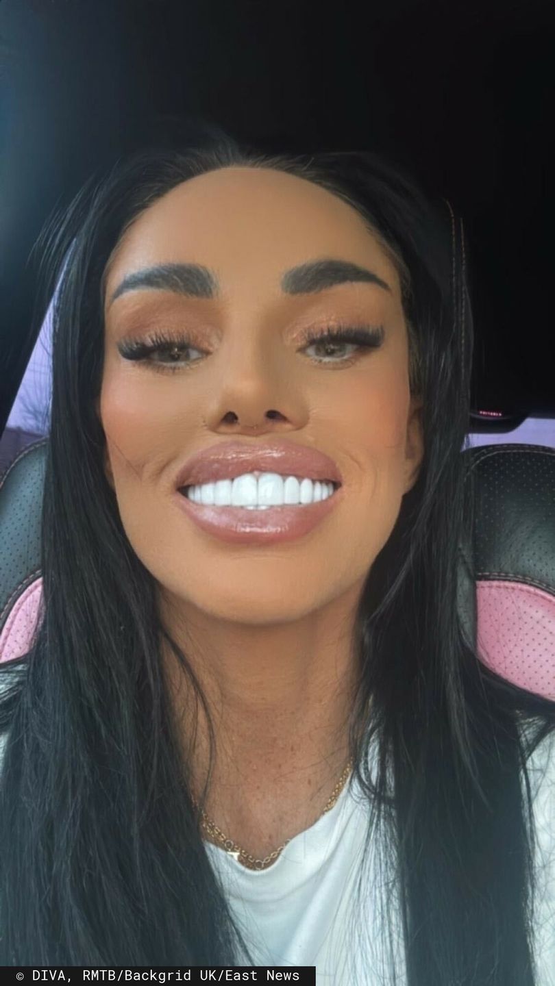 Katie Price pokazuje swój nowy nos