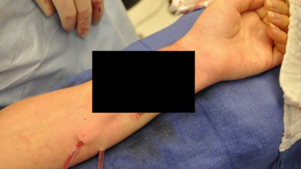 Straciłeś ucho? Możesz wyhodować sobie nowe. Na własnej ręce 1