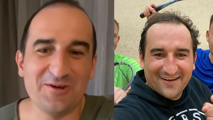 Misiek Koterski pokazuje włosy po przeszczepie i tłumaczy: "ONE WYPADAJĄ NAJPIERW"