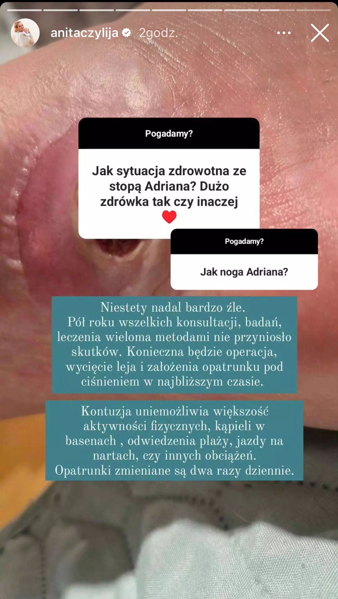 Anita pokazała dziurę w stopie męża