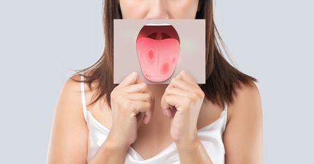 Leukoplakia – objawy, przyczyny, leczenie