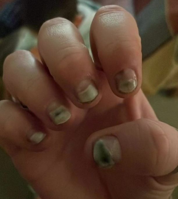 Paznokcie Ally były w opłakanym stanie