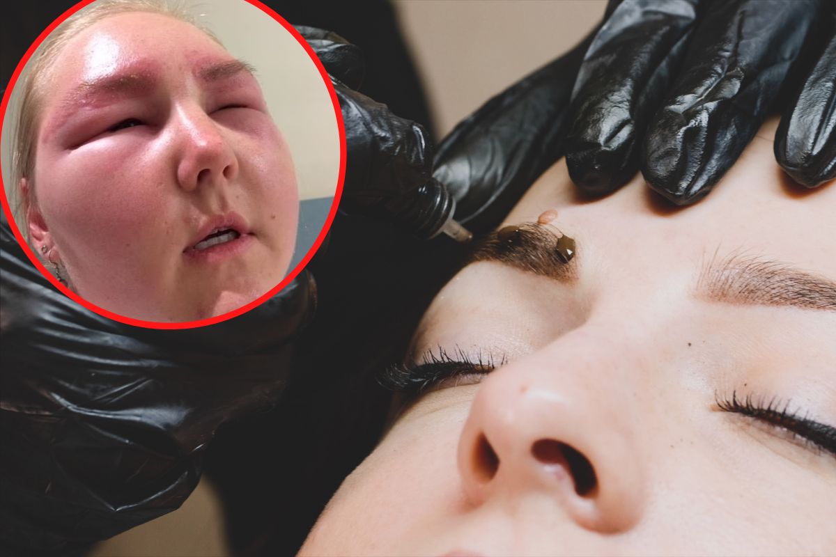 Bała się, że będzie musiała odwołać ślub. Przez wizytę u kosmetyczki straciła wzrok i trafiła do szpitala