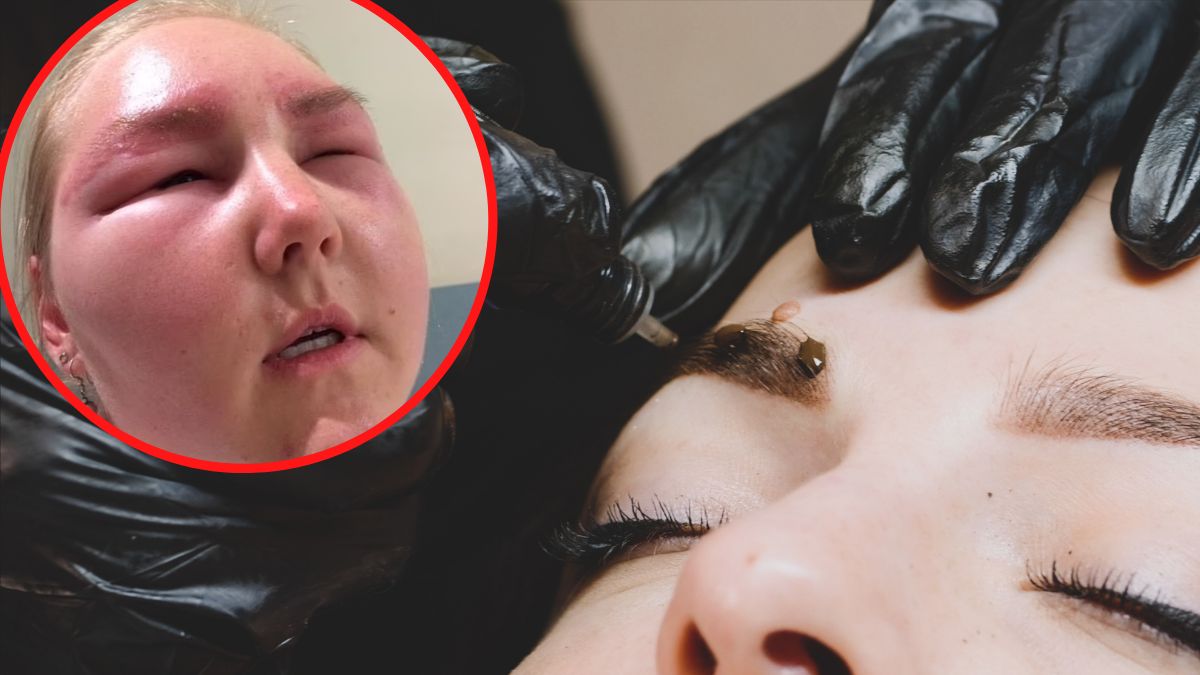 Bała się, że będzie musiała odwołać ślub. Przez wizytę u kosmetyczki straciła wzrok i trafiła do szpitala