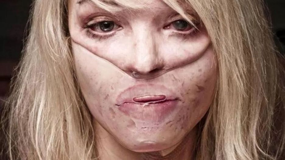 Katie Piper w 2008 r. została oblana kwasem