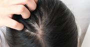 Swędzenie skóry głowy - nietypowy objaw chorej tarczycy