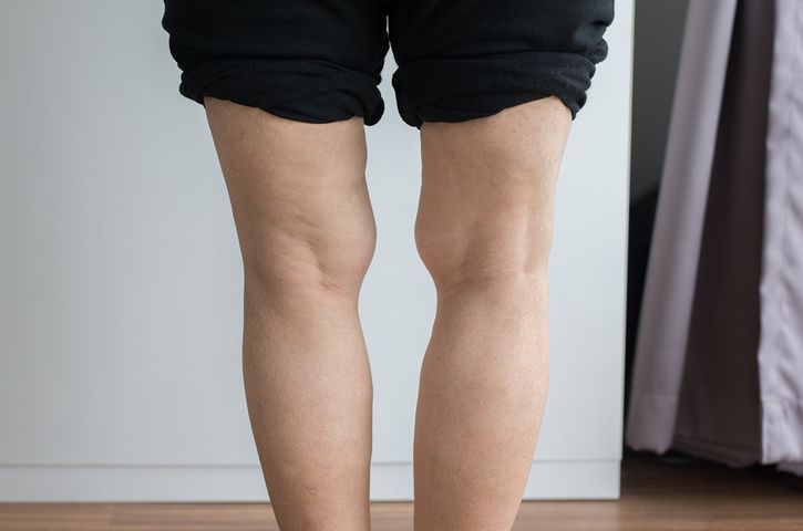 Koślawość kolan u dzieci do 6. roku życia jest naturalna i nie powinna budzić niepokoju