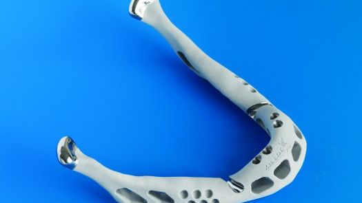 Pierwsza prawdziwa sztuczna szczęka już wszczepiona 1