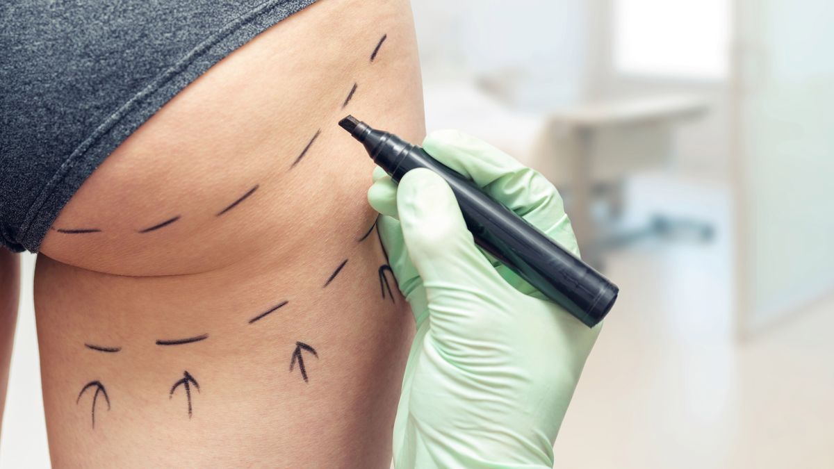 plastic surgeon marking womans body for plastic surgery