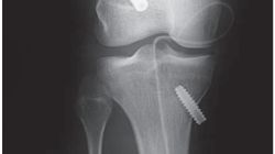 Migracja piszczelowej śruby interferencyjnej po rekonstrukcji ACL