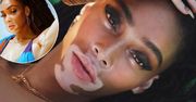 Winnie Harlow z choroby zrobiła swój znak rozpoznawczy. Jest pięknością, która się wyróżnia