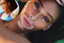 Winnie Harlow z choroby zrobiła swój znak rozpoznawczy. Jest pięknością, która się wyróżnia