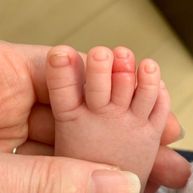 Czasami wystarczy chwila nieuwagi, by włos owinął się wokół palca malucha