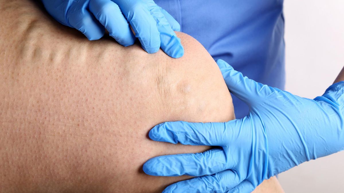 Angiolog to potocznie lekarz od żył