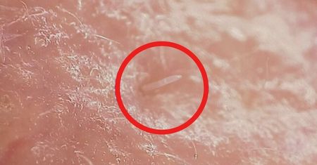 Są całkowicie zależne od ludzi. Żyją na naszej skórze
