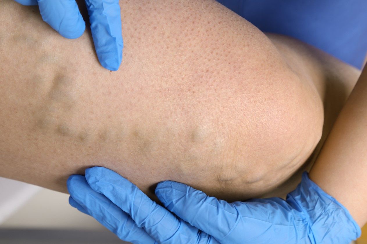 Morsowanie a żylaki - jakie są przeciwskazania do morsowania?