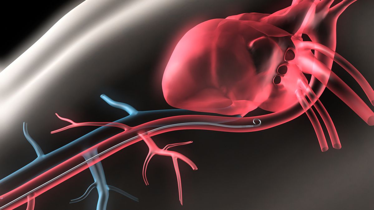 Zespołem MAS nazywamy napadowe występowanie bloku przewodzenia przedsionkowo-komorowego