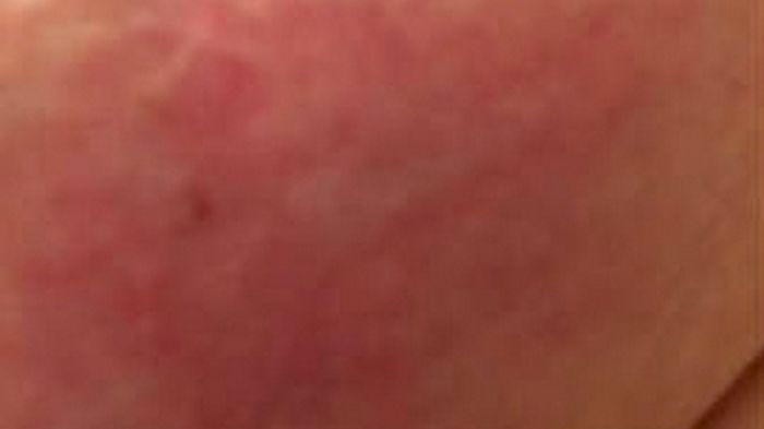 Rak zapalny piersi – groźny i dynamiczny nowotwór