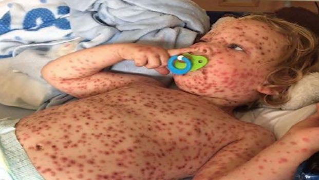 Najgorszy przypadek ospy wietrznej wystąpił u dwulatka